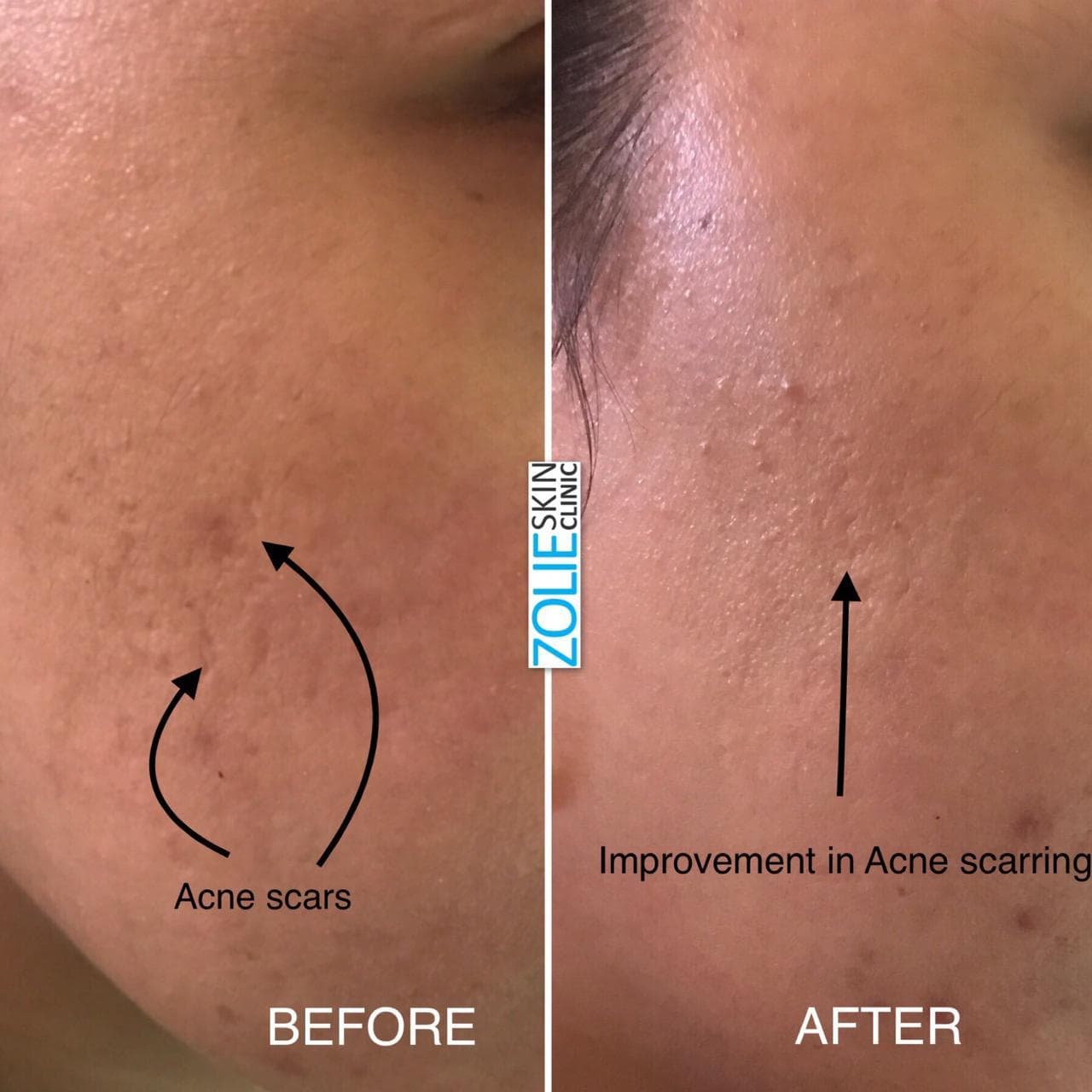 Before and after treatment result 2 at Zolie Skin Clinic