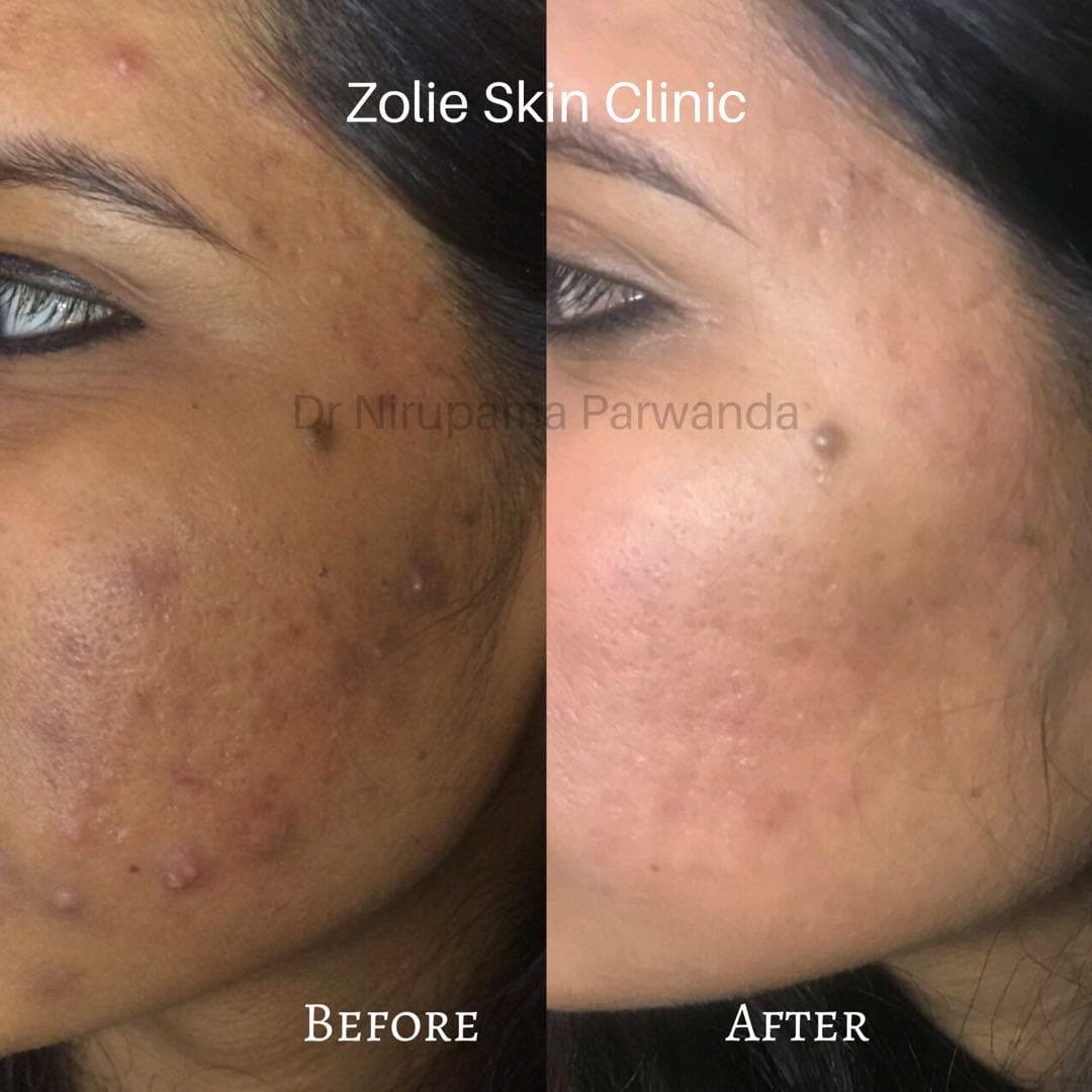 Before and after treatment result 3 at Zolie Skin Clinic